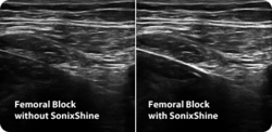Ultrasound Needle Enhancement Technology SonixShine